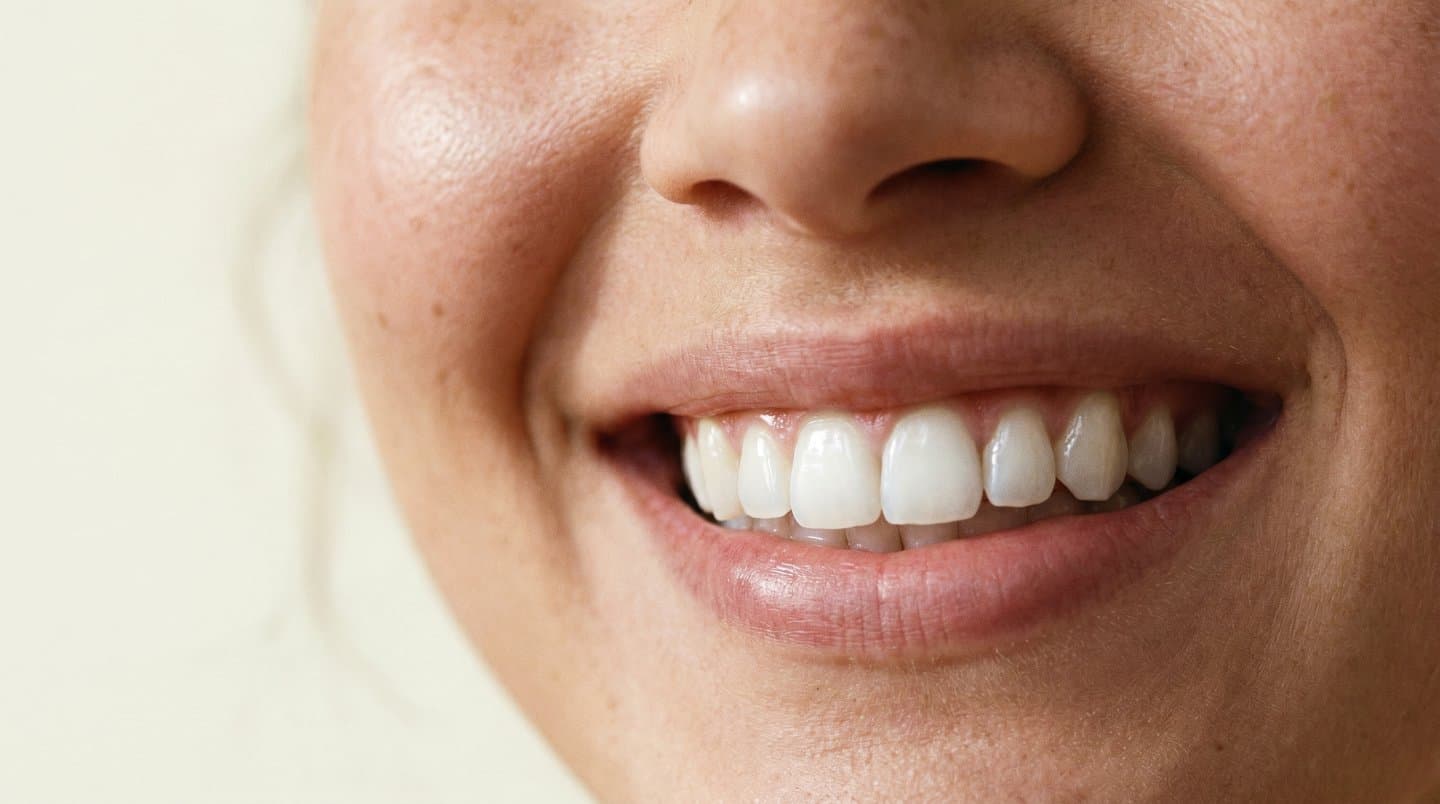 Bright, healthy smile after professional teeth whitening