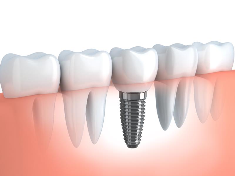 Dental Implants Tracy, CA